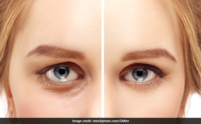 Get Rid of Dark Circles Under Eyes and Bags Under Your Eyeserection
