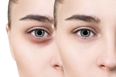 Get Rid of Dark Circles Under Eyes and Bags Under Your Eyeserection