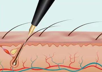 What Is Electrolysis Hair Removal?